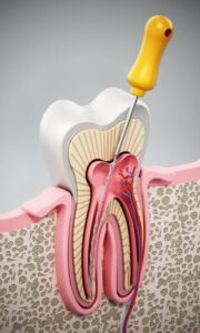 L'endodontie est la solution pour une infection de la pulpe dentaire