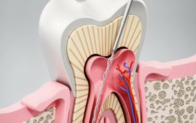 Je vous raconte la fois où j’ai fait un traitement endodontique