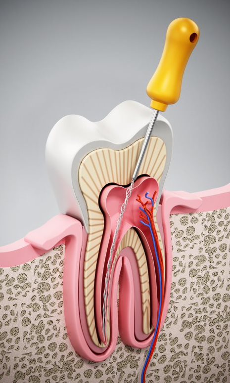 L'endodontie est la solution pour une infection de la pulpe dentaire