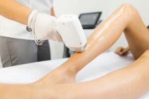 epilation laser femme